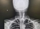 القنفذة.. تدخّل جراحي يُنقذ حياة مريض ابتلع مفتاح سيارته