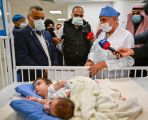 بدء عملية فصل التوأم السيامي العراقي “على وعمر”