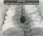 مركز الأمير سلطان لطب وجراحة القلب يُنقذ حياة طفلة تبلغ من العمر يوم