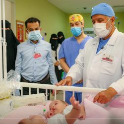 #شاهد مراحل #فصل_التوام_السيامي_اليمني