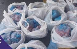 انهاء معاناة حاجة ماليزية من ورم ليفي ضخم بتجمع مكة المكرمة الصحي